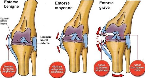 Blessures articulaires