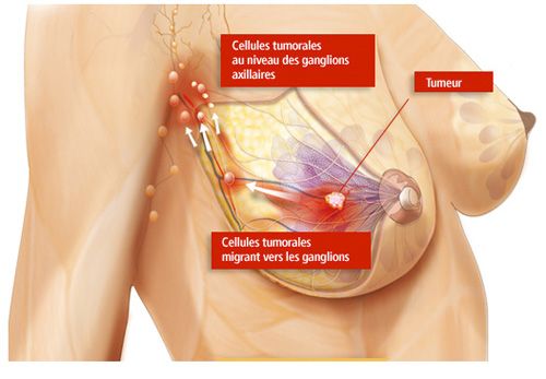 Le drainage lymphatique manuel