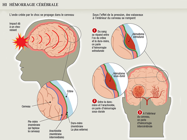 Traumatismes crâniens et AVC